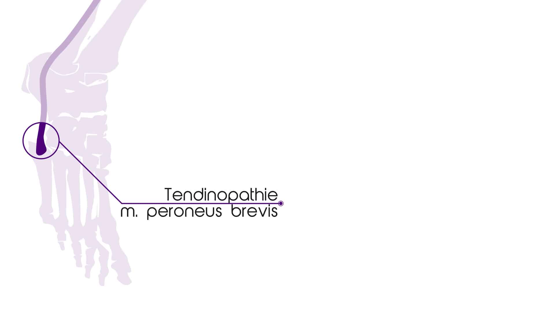Tendinopathie m. peroneus brevis